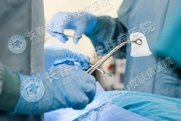 治脓疱型银屑病有什么误区呢?