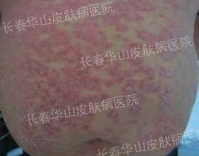 腹部银屑病治愈，还他朝气蓬勃