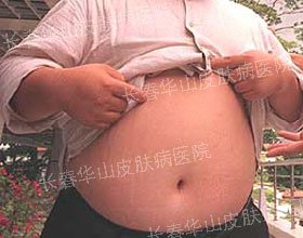 腹部银屑病治愈，还他朝气蓬勃